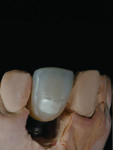 Fig 17 and Fig 18. The author fabricated a screw-retained restoration for the implant-restored site and a ceramic chip to be added to the mesial incisal fracture.