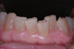 Unwanted tooth movement is a sign of instability in the dentition.