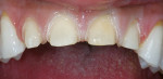 Figure 2  The preexisting veneers were removed to expose the prepared teeth.