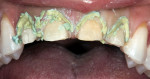 Figure 3  Expasyl gingival retraction system was placed in the gingival sulcus.