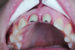 Fig 14. Palatal view demonstrates excellent tissue control.
