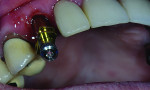 Fig 1. Implantlevel impression.