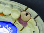 Fig 2. Screw-retained diagnostic wax-up.