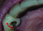 Fig 7. Zirconia support in functional areas.