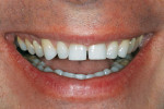 Figure 1  The patient presented with short incisors,diastemas between his teeth, and a reversesmile line with excessive gingival display on theright side.