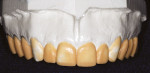 Figure 2  A maxillary arch wax-up of the proposedveneer restorations was fabricated basedon the patient-approved computer imaging.