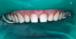 Figure 3  The completed preparations of teethNos. 3 through 14. Note that enamel remains onall surfaces, and the tissue level was raised onteeth Nos. 3 through 5.