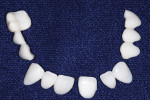 Figure 4  The indirect Radica provisional restorations were created on a Snap-Stone model.