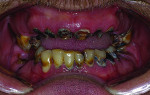 Pretreatment view of patient with chronic tooth decay.