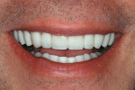 Figure 7  The provisional restorations (Radica) while in natural smile.