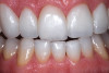 (5.) Placement of composite into tooth No. 19.