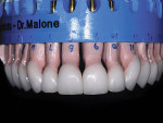 Figure 9  Completed IPS e.max Press lithium disilicate restorations on the laboratory model.