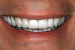 Figure 10  Postoperative view of the patient’s natural smile. Note the harmonious esthetic result achieved with the pressed and layered lithium disilicate (IPS e.max Press) veneers.