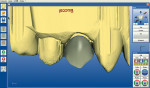 Figure 5  CEREC software proposal for a full crown on tooth No. 5.