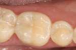 Figure 7  The tooth was etched and bonded, and composite was placed buccally and lingually on the occlusal surfaces to minimize C-factor issues.