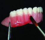Fig 5 and Fig 6. Flowable red (F-Gum-R) is applied one quadrant at a time.