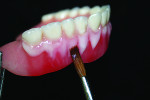 Fig 8. Every surface where composite was applied (gingiva and/or teeth) is coated with Oxy-Barrier.