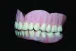 Fig 2. Rebasing or relining the existing denture.
