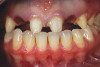 Fig 5. While the stain is still wet, it can be helpful to “dust” the crowns with an incisal effect.