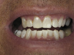 Immediate post-treatment result after completion of 8-week protocol; comparison to pretreatment photograph (Figure 1) demonstrates dramatic improvement.