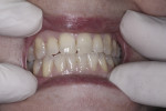 Patient after 2 weeks of twice daily use of Enamelon. Dryness was alleviated, more saliva was present, and the gingival tissues appeared healthier.
