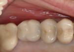 Patient presented with crown on the implant in the No. 14 position that was mobile and associated with 8-mm probing depths with bleeding on probing and suppuration.