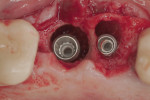 A combination of drills and BAOSFE was done to place a 5.0-mm x 11.0-mm implant in the site of tooth No. 14.
