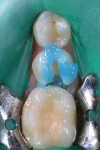 Completed preparation on tooth No. 29 with exposed dentin and remaining enamel. Selective enamel etching using 34% phosphoric acid, applied for 15 seconds.