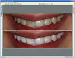 Figure 1  Screen capture of a whitening case using the Dentrix Cosmetic Imaging program. Image courtesy of Dentrix Image from DEXIS.