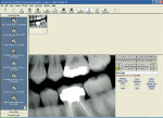 Figure 2  Screen capture of the Advanced Imaging module in EagleSoft. Image courtesy of Patterson Dental.