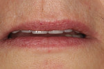 Figure 9 After treatment completion, incisor display with the lips in repose.