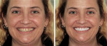 Figure 7  This patient wanted her whole smile redone but wanted to see what it might look like as she was unsure of what she wanted. After looking at photographs the author and the patient found aspects of smiles she liked and other things that she d