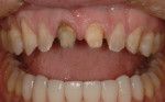Facial view demonstrating 0.8-mm facial reduction of laterals and canines.