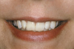 Figure 2  Pretreatment smile view.