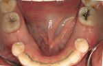Figure 3  Completed mandibular orthodonticswith fixed retainer in place.