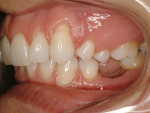 Figure 4  Orthodontics completed on the left sidewith remaining edentulous area in site No. 20.