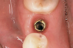 Figure 5  Implant installed at site No. 29.