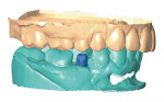 Figure 7b  Atlantis custom abutment CAD/CAM design file, facial view with opposing virtual cast.