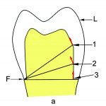 Fig 6. When a load (L) is applied to the occlusal surface of the restoration, it wants to “tip,” or be dislodged, and the restoration will want to rotate around a fulcrum point (F).