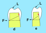 Fig 7. The height and width of the preparation form will significantly affect resistance form. The taller and narrower the form, the more resistance form is present.