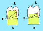 Fig 8. The shorter and wider the preparation form, the less resistance form is present.