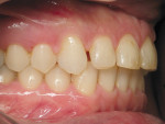 Figure 7  Right lateral view after orthodontic treatment.