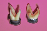 (Left) Unadapted crown form on unprepared primary first molar. (Right) Adapted crown form luted to prepared primary first molar, shown after 6 years in the mouth.