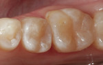 The completed disto-occlusal SonicFill 2 composite restoration on tooth No. 29 is shown from the occlusal aspect. An occlusal SonicFill 2 restoration was completed on tooth No. 30 at a previous appointment.