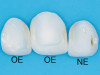 Fig 1. Preoperative condition of fractured teeth.