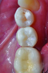 Figure 9 The final restoration on tooth No. 29 showing excellent color, contour, and interproximal contact. The restoration was completed efficiently using the DENTSPLY Class II Total Practice Solution, which allowed the author to work faster and still provide an outstanding clinical result.