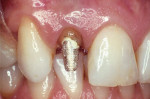 Figure 2A Alumina and zirconia restorations can successfully block out tooth discoloration, but its white opaque core also challenges the esthetic outcome of the restoration.