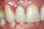 Figure 2B Alumina and zirconia restorations can successfully block out tooth discoloration, but its white opaque core also challenges the esthetic outcome of the restoration.