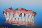 Figure 5 Facial view of impression component of intraoral scan (iTero®, Align Technology).