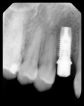 Figure 7 Radiograph of the left maxillary implant, im- mediately after placement.